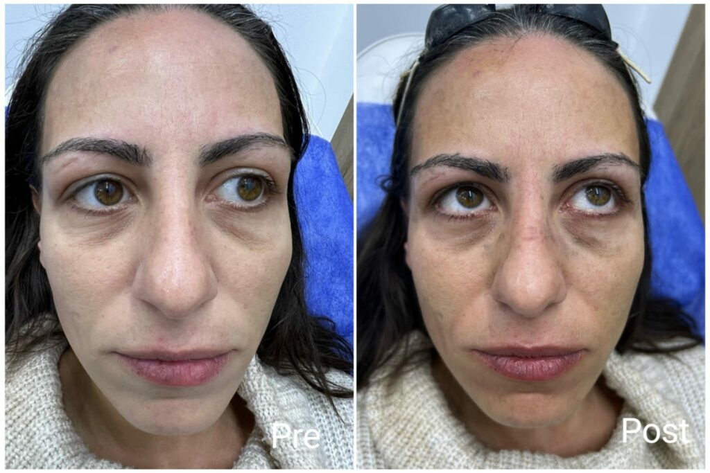 One session for facial freshness and lip plumping